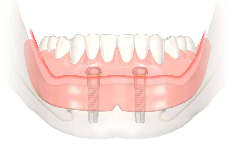 Implants