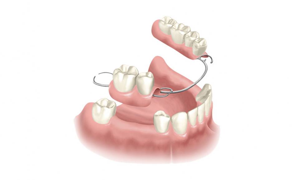 Partial Denture
